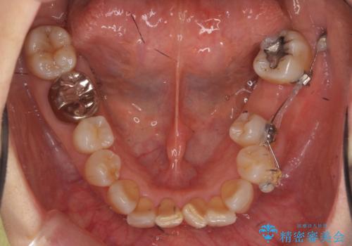 奥歯が割れた インプラントは不向き 部分矯正後、ブリッジで治療の治療中