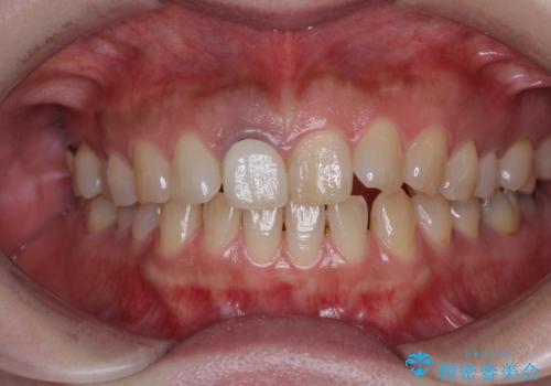 白すぎる前歯と虫歯の奥歯 セラミック治療の治療前