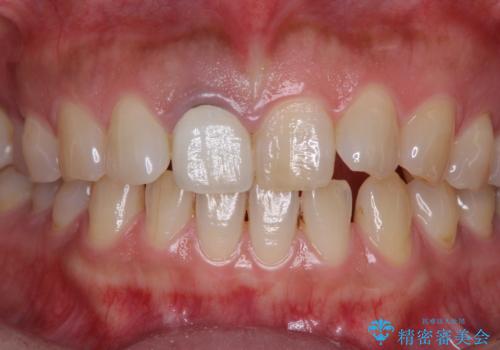 白すぎる前歯と虫歯の奥歯 セラミック治療の治療前