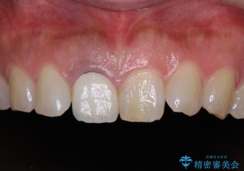 白すぎる前歯と虫歯の奥歯　セラミック治療の症例 治療前