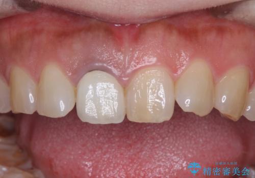 白すぎる前歯と虫歯の奥歯 セラミック治療の治療前