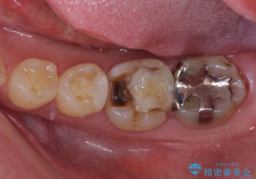 白すぎる前歯と虫歯の奥歯 セラミック治療の治療前