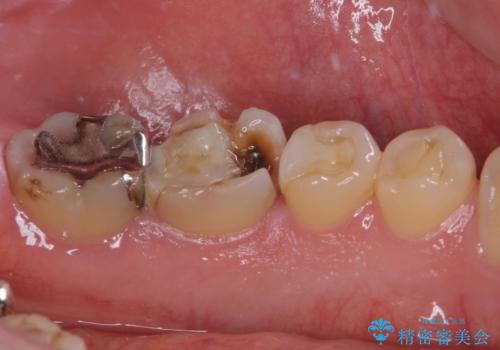 白すぎる前歯と虫歯の奥歯 セラミック治療の治療前