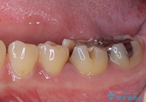 白すぎる前歯と虫歯の奥歯 セラミック治療の治療前