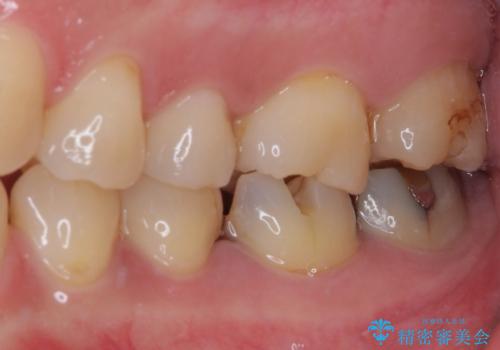 白すぎる前歯と虫歯の奥歯　セラミック治療の治療前