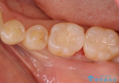 他院で虫歯と言われた。の治療後