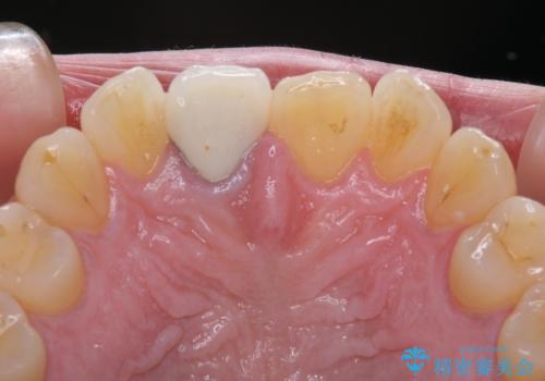 白すぎる前歯と虫歯の奥歯 セラミック治療の治療前