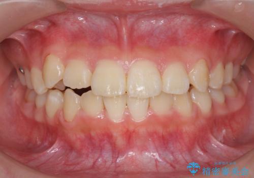 インビザラインで行う八重歯の治療の治療中