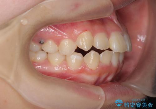 インビザラインで行う八重歯の治療の治療中