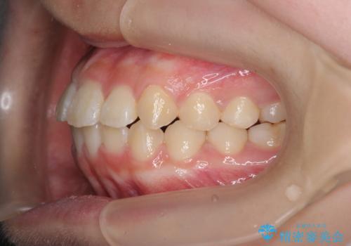 インビザラインで行う八重歯の治療の治療中