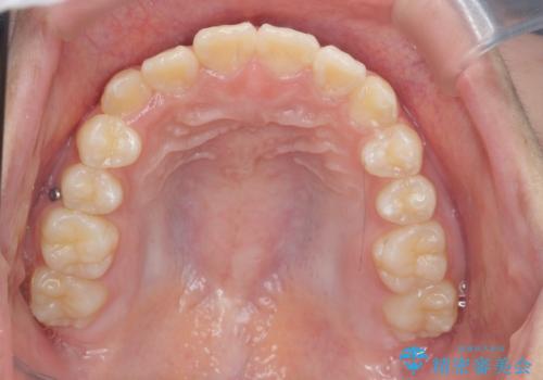 インビザラインで行う八重歯の治療の治療中