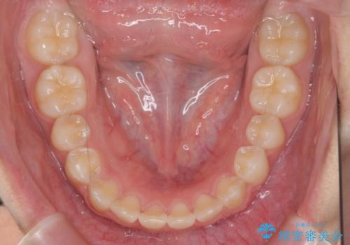 インビザラインで行う八重歯の治療の治療中