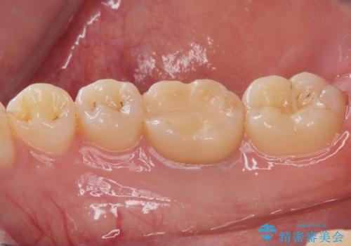 樹脂をセラミックにしたい ジルコニアクラウンでの治療の治療前