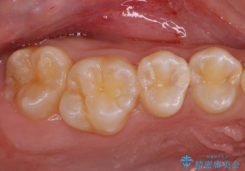 歯と歯の間の虫歯 セラミックインレーでの治療の治療前