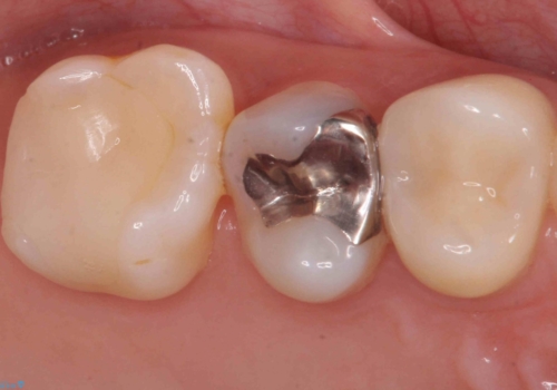 銀歯を白くしたいの治療前