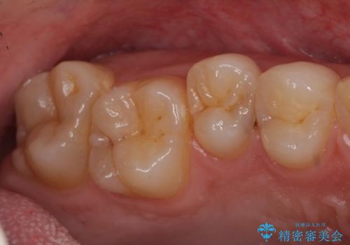 歯と歯の間の虫歯 セラミックインレーでの治療の治療前