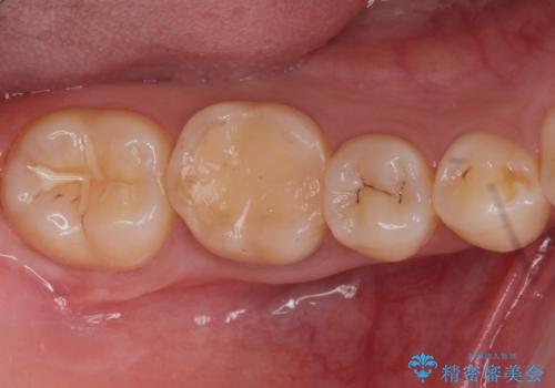 樹脂をセラミックにしたい ジルコニアクラウンでの治療の症例 治療前