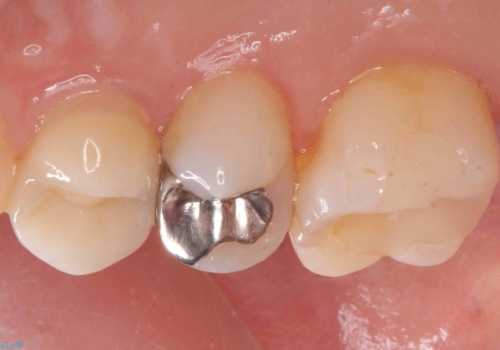 銀歯を白くしたいの治療前