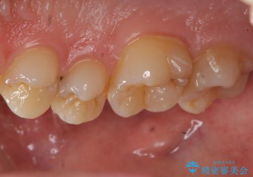 歯と歯の間の虫歯 セラミックインレーでの治療の治療前
