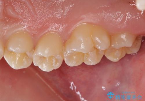 歯と歯の間の虫歯 セラミックインレーでの治療の治療前