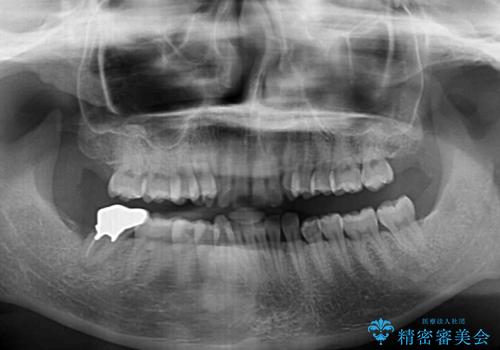 カリエール・ディスタライザーとインビザラインを用いた前歯の咬み合わせ改善の治療前