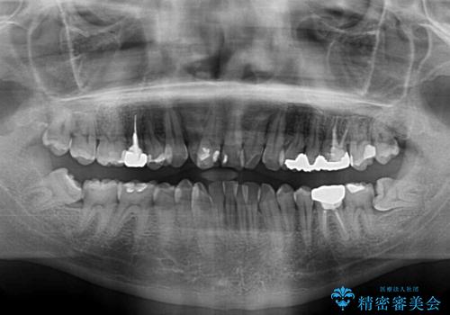 重なって磨きにくい上下の前歯 ワイヤー装置での抜歯矯正の治療前