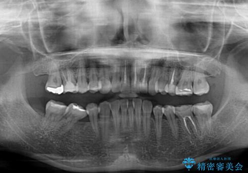 前歯のデコボコと奥歯の咬み合わせをインビザラインで改善の治療前