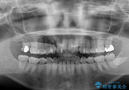【モニター】歯列が狭くデコボコが気になる 急速拡大装置を用いたインビザライン矯正の治療前