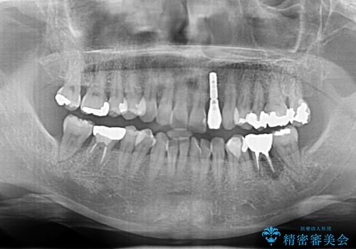 奥歯が割れた　インプラントは不向き　部分矯正後、ブリッジで治療の治療前