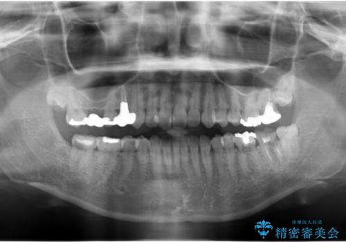 歯科でトラウマ 怖くて行っていなかったが、今度こそきちんと治療したいの治療前