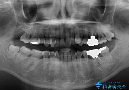 八重歯と先天欠損の歯列　ワイヤー矯正ですっきりとの治療前