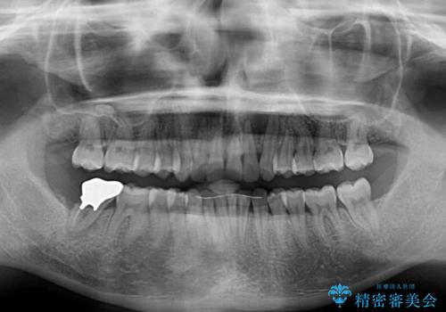 カリエール・ディスタライザーとインビザラインを用いた前歯の咬み合わせ改善の治療後