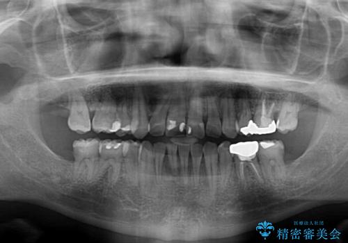 重なって磨きにくい上下の前歯 ワイヤー装置での抜歯矯正の治療後