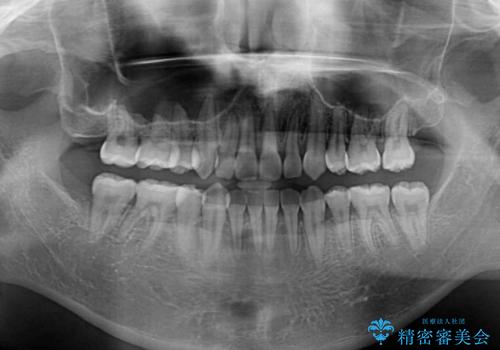 重なり合って磨きにくい前歯 ワイヤー装置での抜歯矯正の治療後