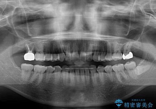 【モニター】歯列が狭くデコボコが気になる　急速拡大装置を用いたインビザライン矯正の治療後