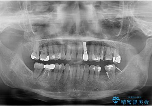 奥歯が割れた インプラントは不向き 部分矯正後、ブリッジで治療の治療中