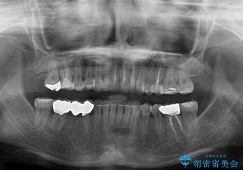 前歯のデコボコと奥歯の咬み合わせをインビザラインで改善の治療後