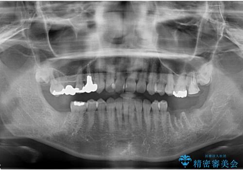 歯科でトラウマ 怖くて行っていなかったが、今度こそきちんと治療したいの治療中