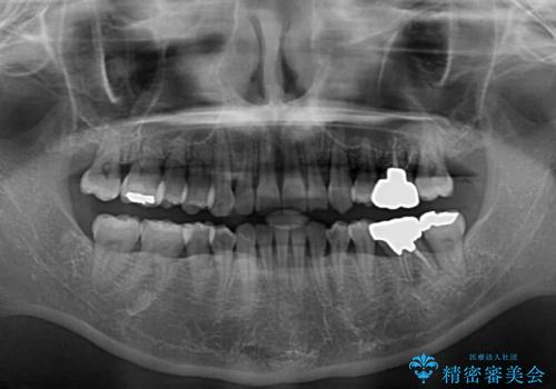 八重歯と先天欠損の歯列 ワイヤー矯正ですっきりとの治療後