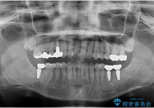 歯科でトラウマ 怖くて行っていなかったが、今度こそきちんと治療したいの治療後