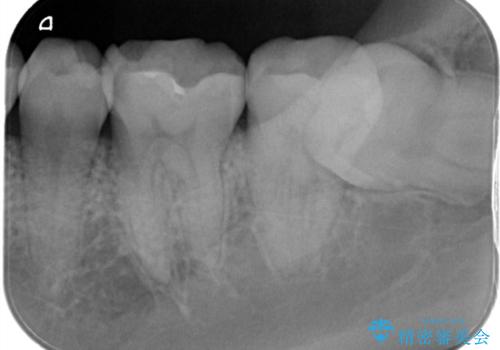 定期検診で虫歯発見。セラミック治療の治療前