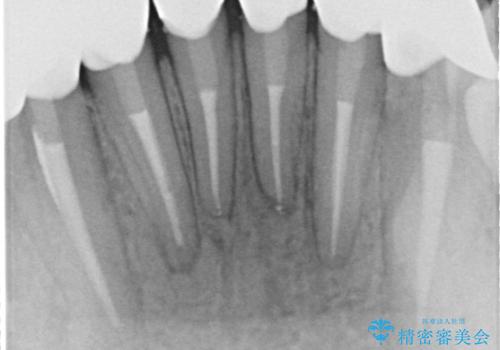 【オールセラミック】下の前歯が痛い。の治療後