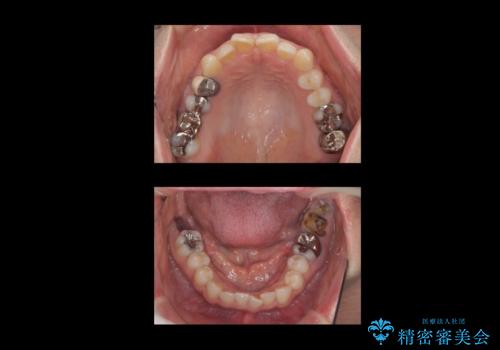 歯科でトラウマ 怖くて行っていなかったが、今度こそきちんと治療したいの治療前