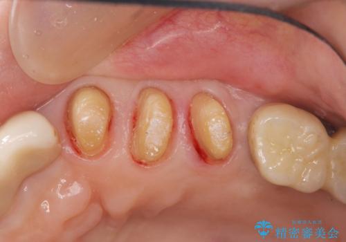 強い咬合力に対抗する歯周補綴の治療中