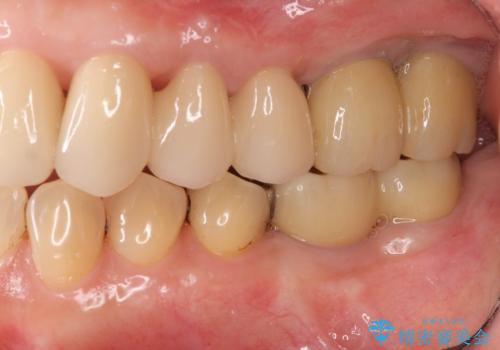 強い咬合力に対抗する歯周補綴の治療後