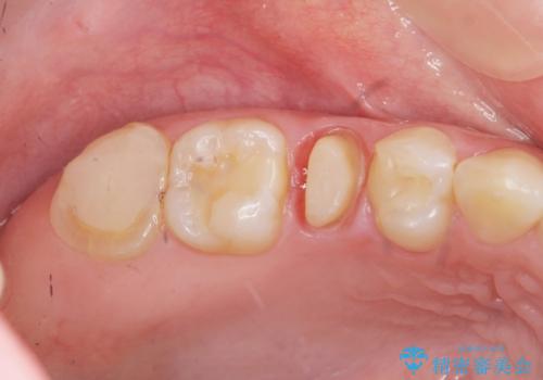 放置した虫歯を外科を行い抜歯を回避の治療前