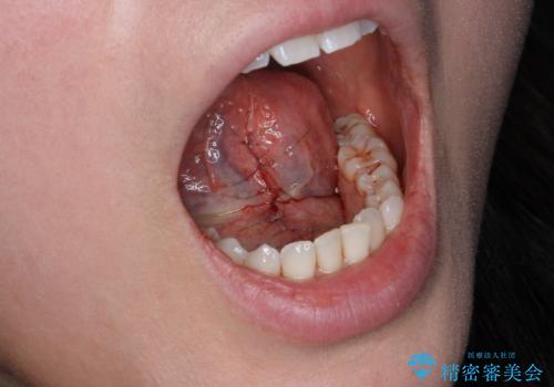 滑舌を改善したい 舌小帯の形成術の治療中