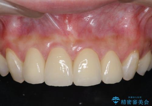 [ 審美歯科 ]  歯並び・色・形を改善!　セラミッククラウン治療の治療後