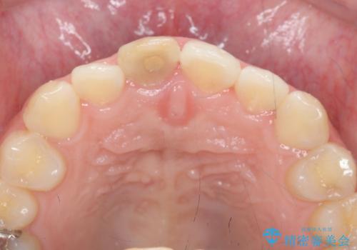 歯ぐきにできものができた 前歯の色調改善の治療前