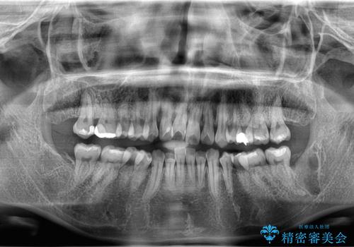【埋伏智歯と埋伏智歯の過剰歯の抜歯】埋まっている親知らず2本の抜歯の治療後